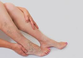 Vein Health: Understanding the Condition and Needs of Professional