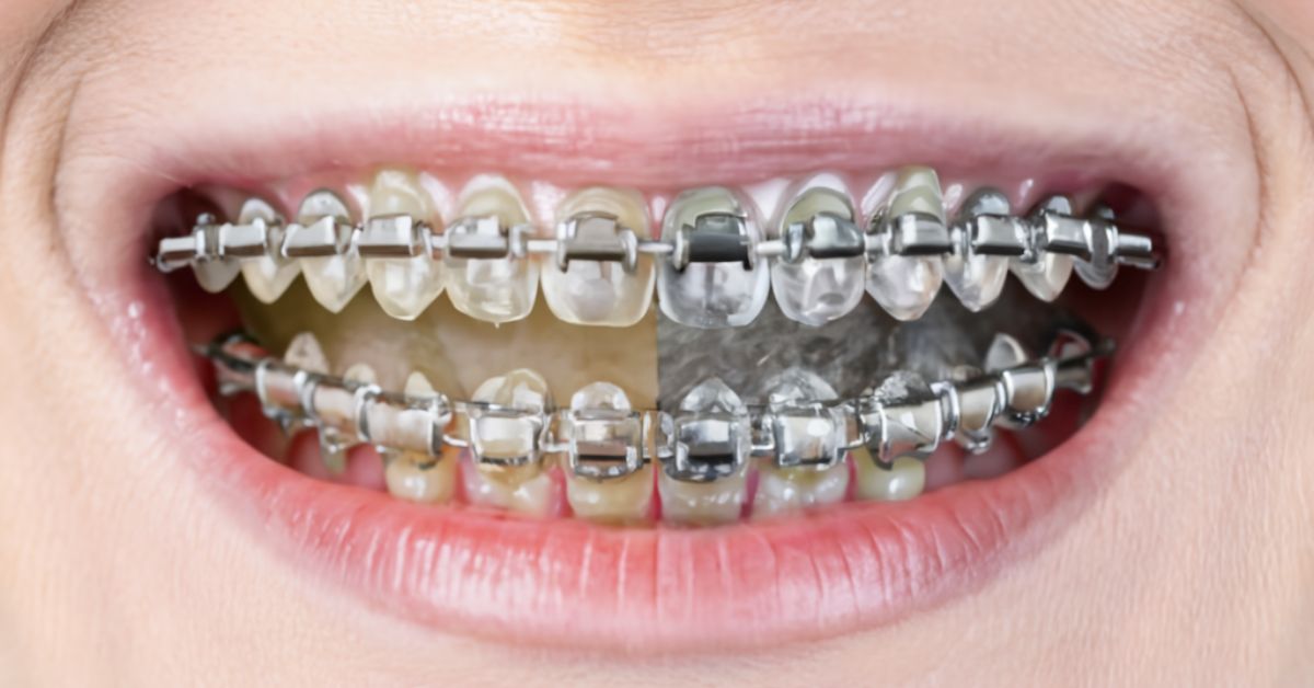 How Does Invisalign Work Compared to Traditional Braces