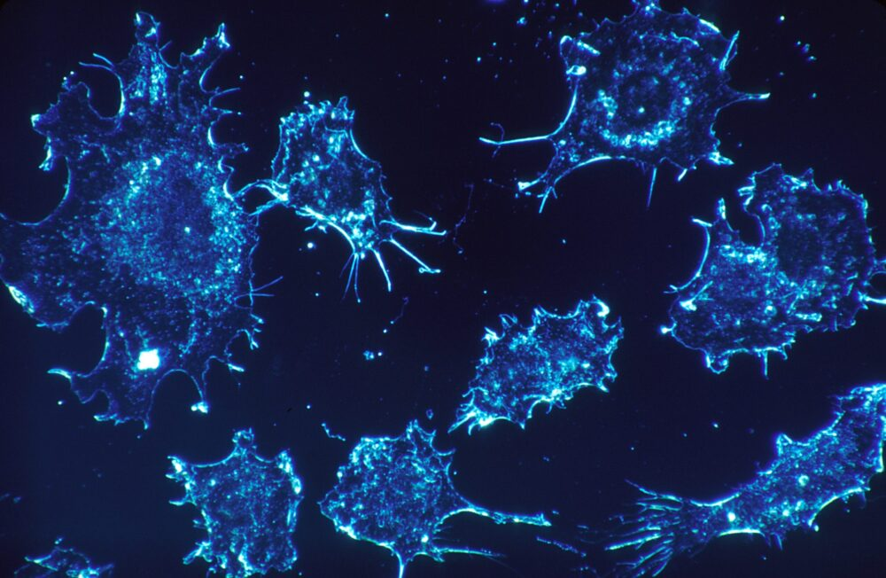 Understanding the Aggressive Nature of Pancreatic Cancer 